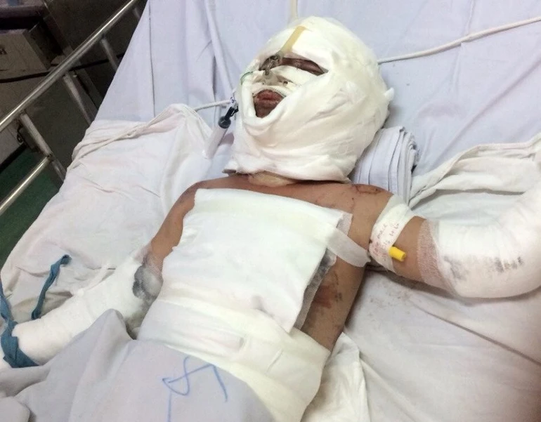 Giúp cháu Huy bị bỏng nặng